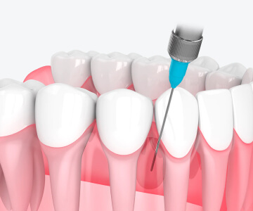 Как проводится плазмолифтинг в стоматологии?